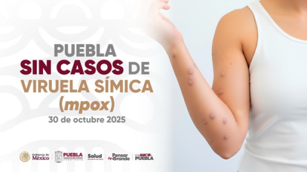 SSa descarta viruela símica en escuelas de Puebla